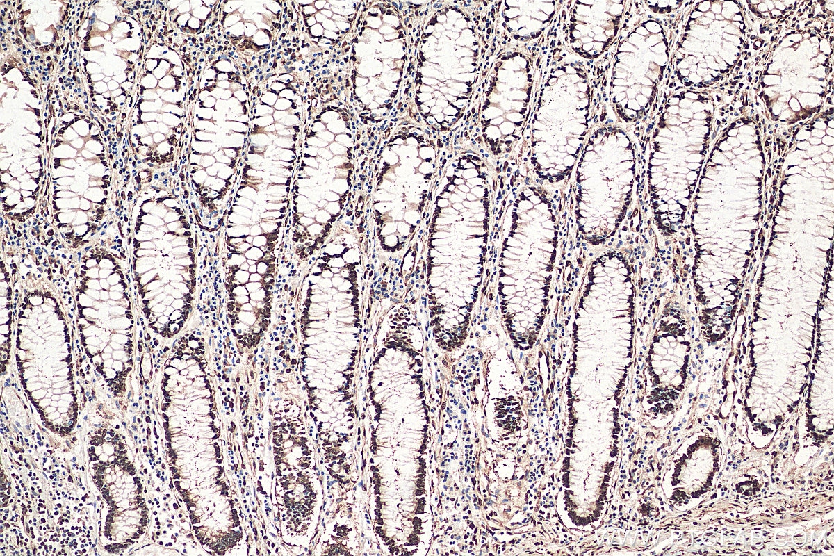 IHC staining of human colon cancer using 10723-1-AP