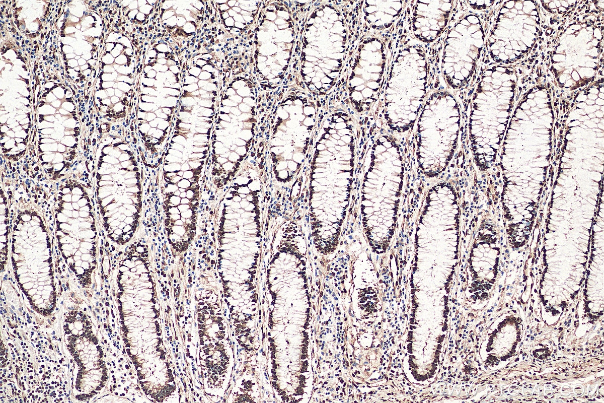 Immunohistochemistry (IHC) staining of human colon cancer tissue using KU70,XRCC6 Polyclonal antibody (10723-1-AP)