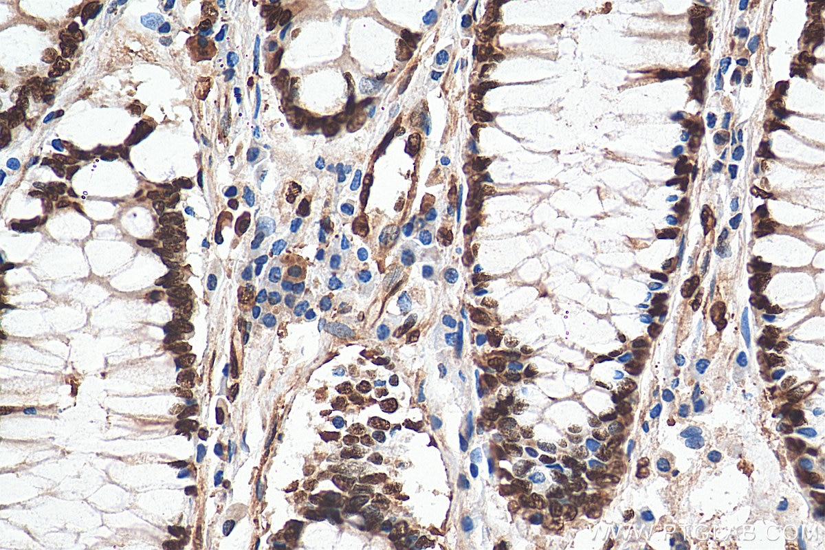 Immunohistochemistry (IHC) staining of human colon cancer tissue using KU70,XRCC6 Polyclonal antibody (10723-1-AP)