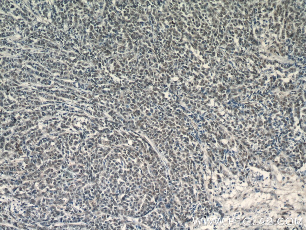 Immunohistochemistry (IHC) staining of human colon cancer tissue using KU70,XRCC6 Polyclonal antibody (10723-1-AP)