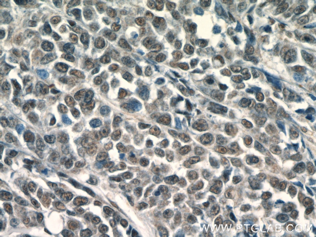 Immunohistochemistry (IHC) staining of human colon cancer tissue using KU70,XRCC6 Polyclonal antibody (10723-1-AP)