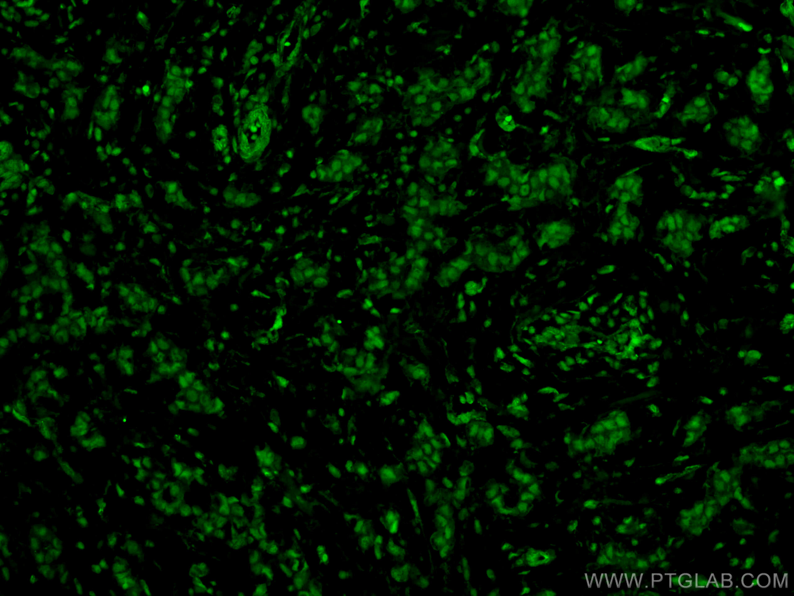 Immunofluorescence (IF) / fluorescent staining of human breast cancer tissue using KU70,XRCC6 Monoclonal antibody (66607-1-Ig)