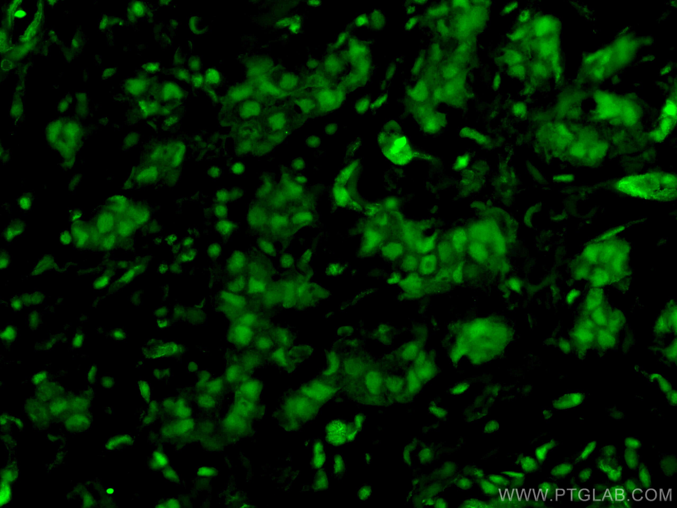 Immunofluorescence (IF) / fluorescent staining of human breast cancer tissue using KU70,XRCC6 Monoclonal antibody (66607-1-Ig)