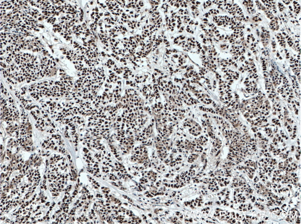 Immunohistochemistry (IHC) staining of human colon cancer tissue using KU70,XRCC6 Monoclonal antibody (66607-1-Ig)