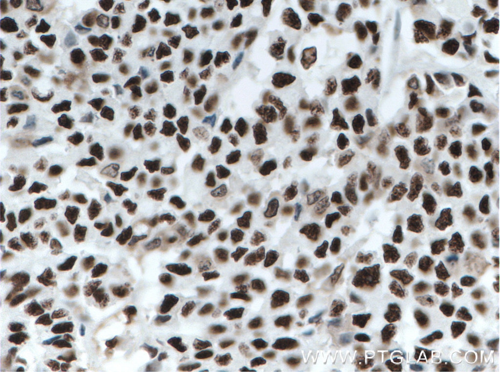 Immunohistochemistry (IHC) staining of human colon cancer tissue using KU70,XRCC6 Monoclonal antibody (66607-1-Ig)