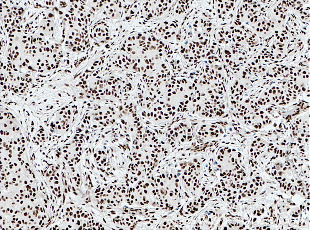 IHC staining of human breast cancer using 66607-1-Ig