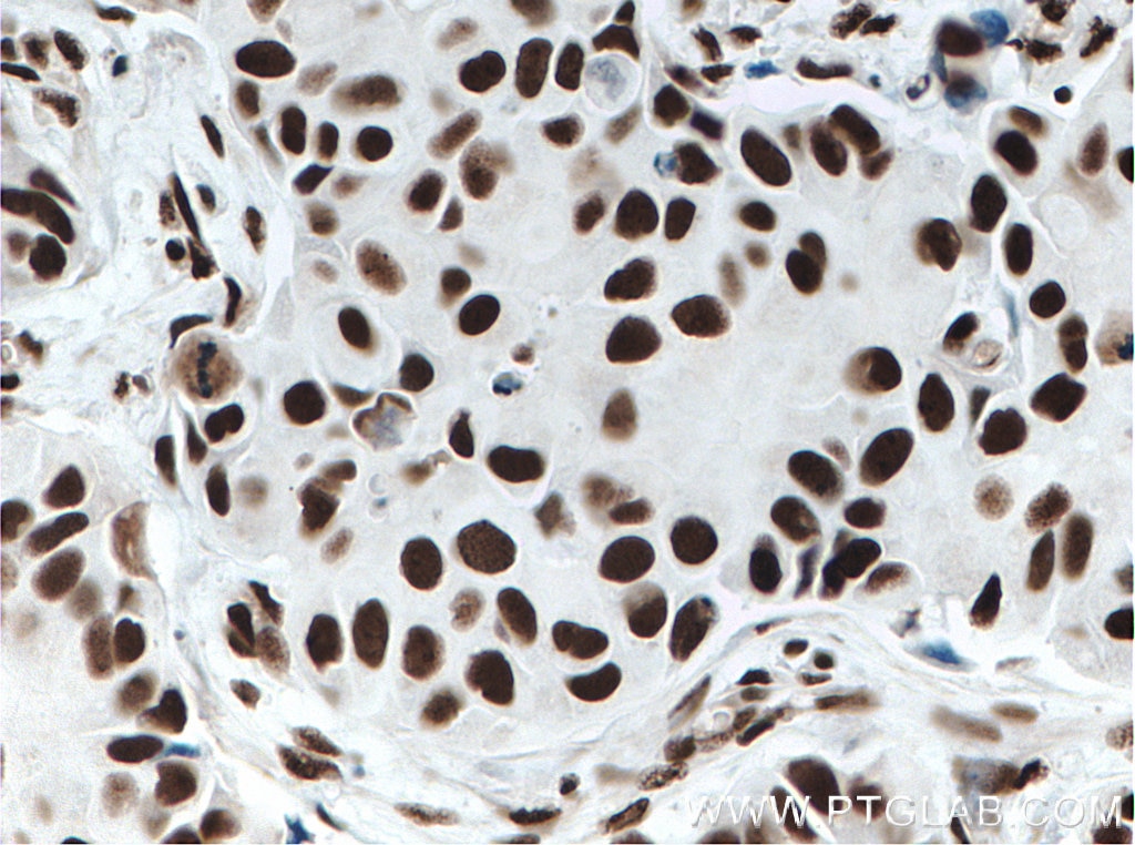Immunohistochemistry (IHC) staining of human breast cancer tissue using KU70,XRCC6 Monoclonal antibody (66607-1-Ig)