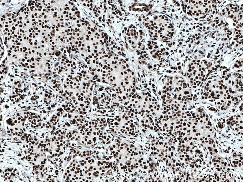 Immunohistochemistry (IHC) staining of human breast cancer tissue using KU70,XRCC6 Monoclonal antibody (66607-1-Ig)