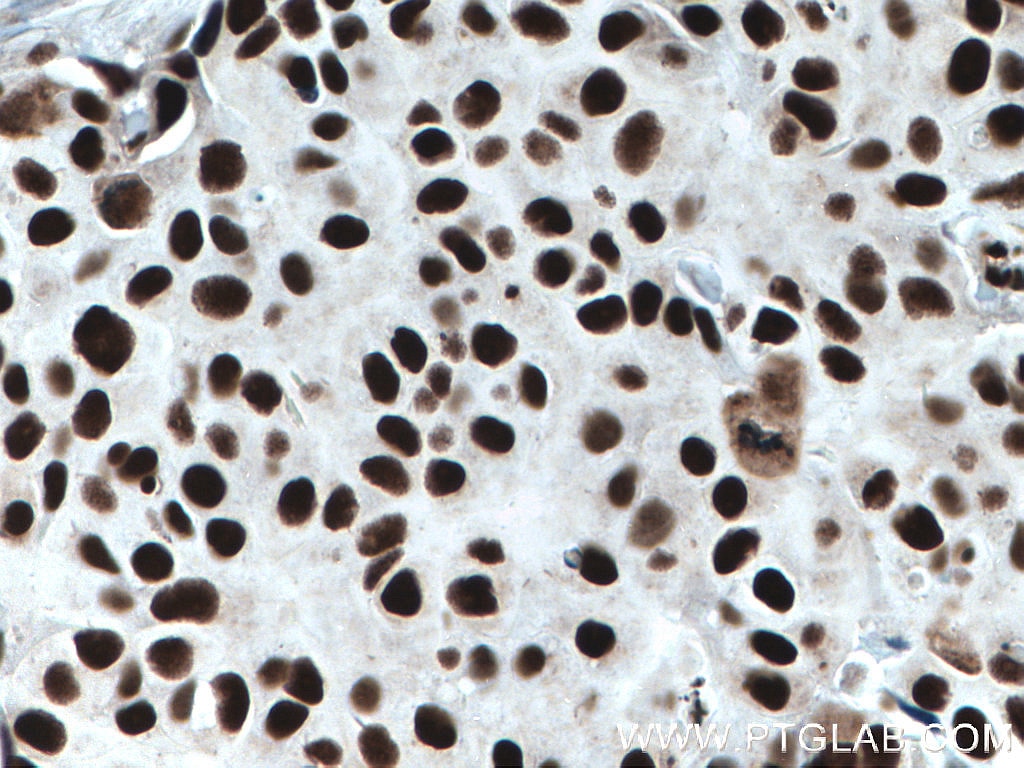 Immunohistochemistry (IHC) staining of human breast cancer tissue using KU70,XRCC6 Monoclonal antibody (66607-1-Ig)