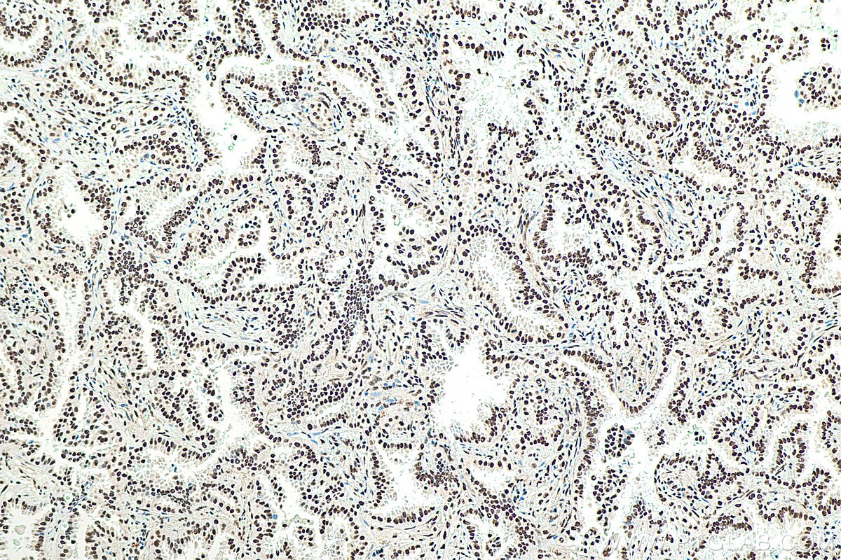 Immunohistochemistry (IHC) staining of human lung cancer tissue using KU70,XRCC6 Monoclonal antibody (66607-1-Ig)