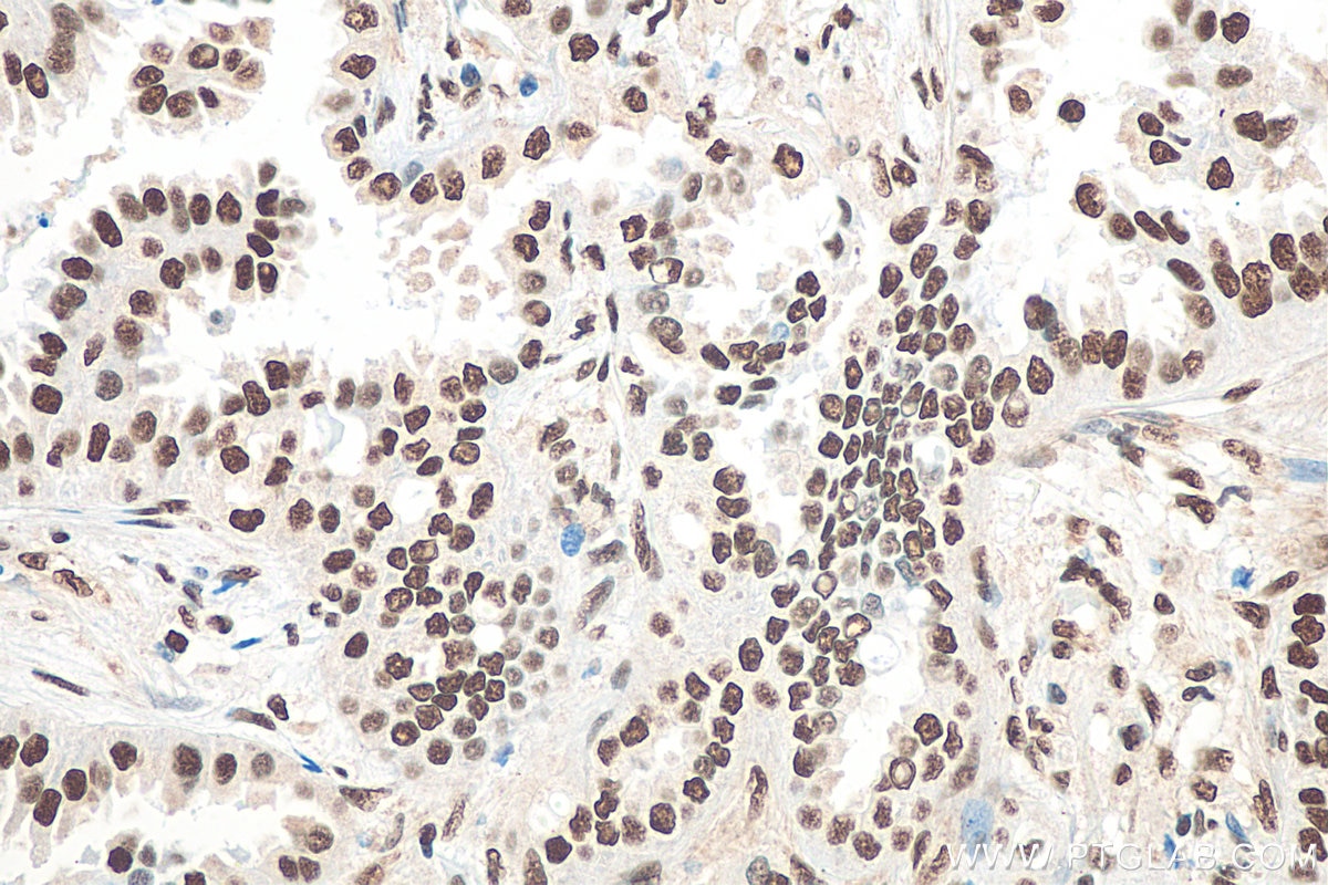 Immunohistochemistry (IHC) staining of human lung cancer tissue using KU70,XRCC6 Monoclonal antibody (66607-1-Ig)