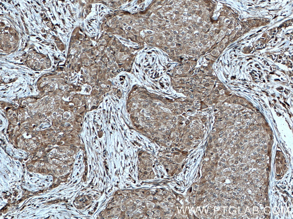 Immunohistochemistry (IHC) staining of human breast cancer tissue using KYNU Polyclonal antibody (11796-1-AP)