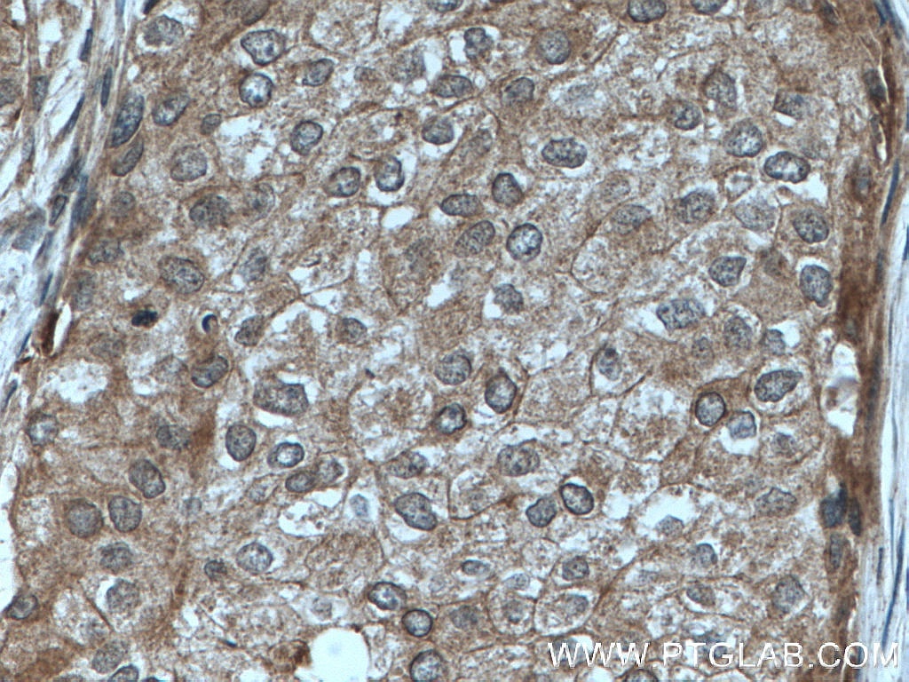 Immunohistochemistry (IHC) staining of human breast cancer tissue using KYNU Polyclonal antibody (11796-1-AP)