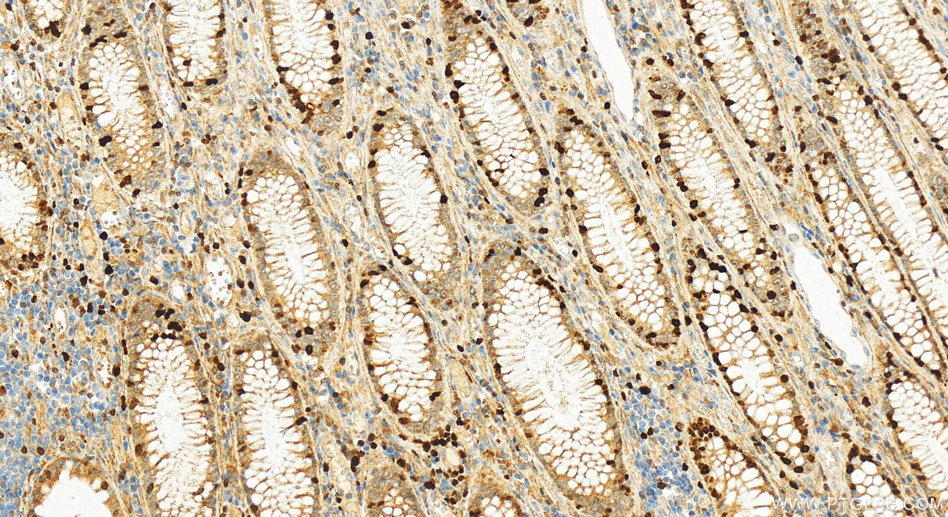 Immunohistochemistry (IHC) staining of human colon cancer tissue using Ki-67 Polyclonal antibody (32270-1-AP)