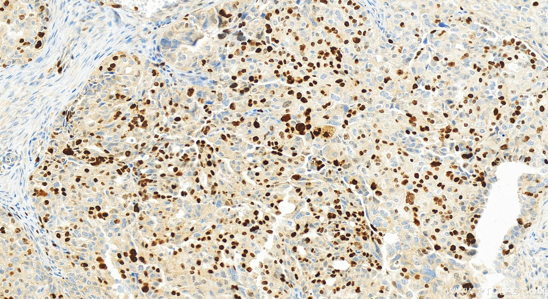 Immunohistochemistry (IHC) staining of human ovary cancer tissue using Ki-67 Polyclonal antibody (32270-1-AP)