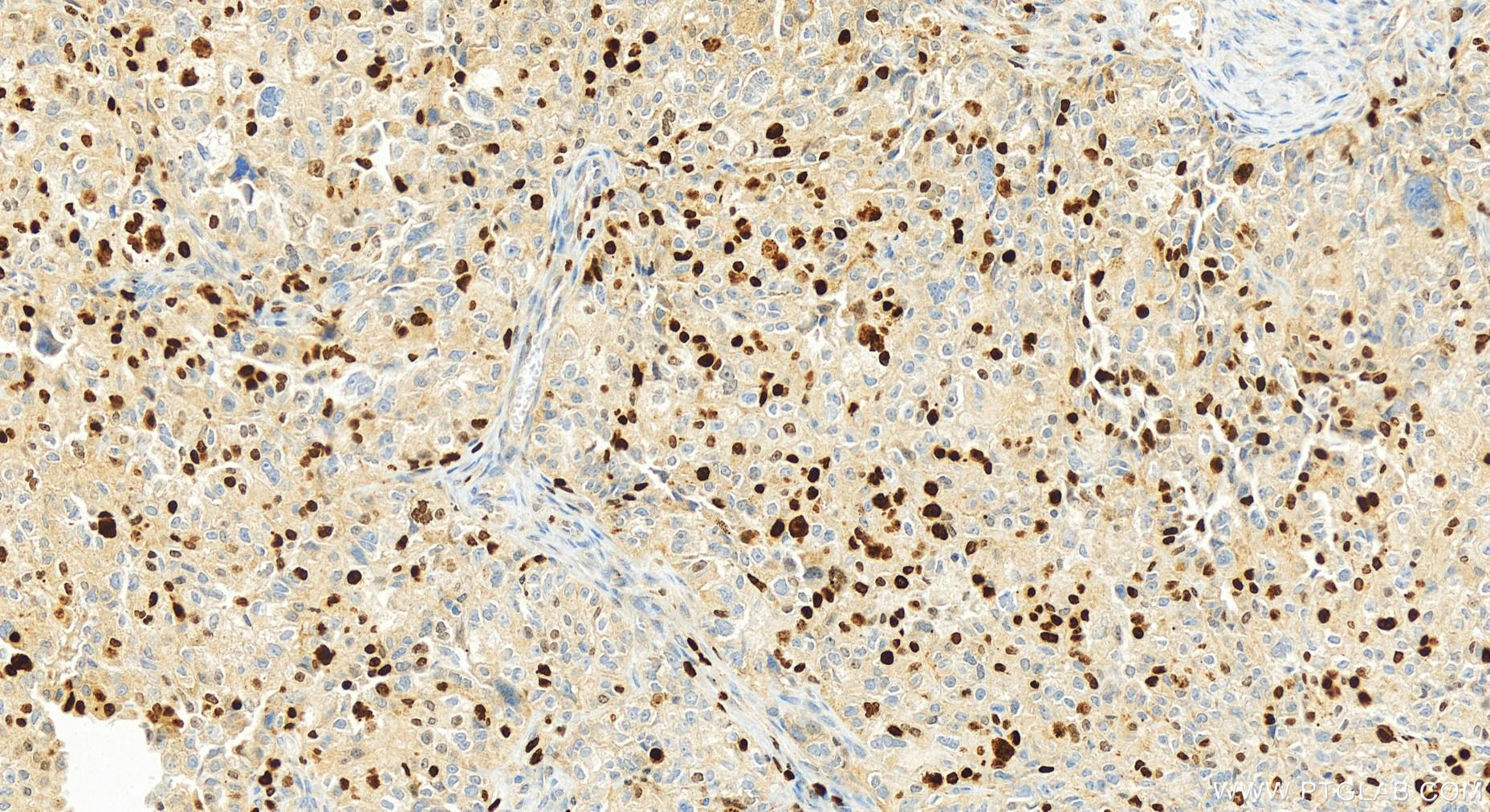 Immunohistochemistry (IHC) staining of human ovary cancer tissue using Ki-67 Polyclonal antibody (32270-1-AP)