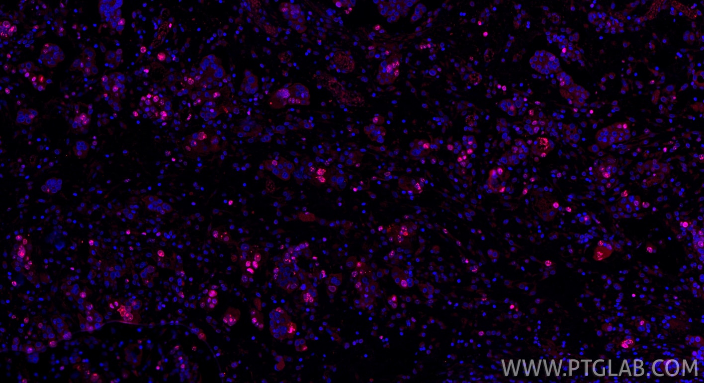 Immunofluorescence (IF) / fluorescent staining of human ovary cancer tissue using Ki-67 Monoclonal antibody (66555-6-Ig)