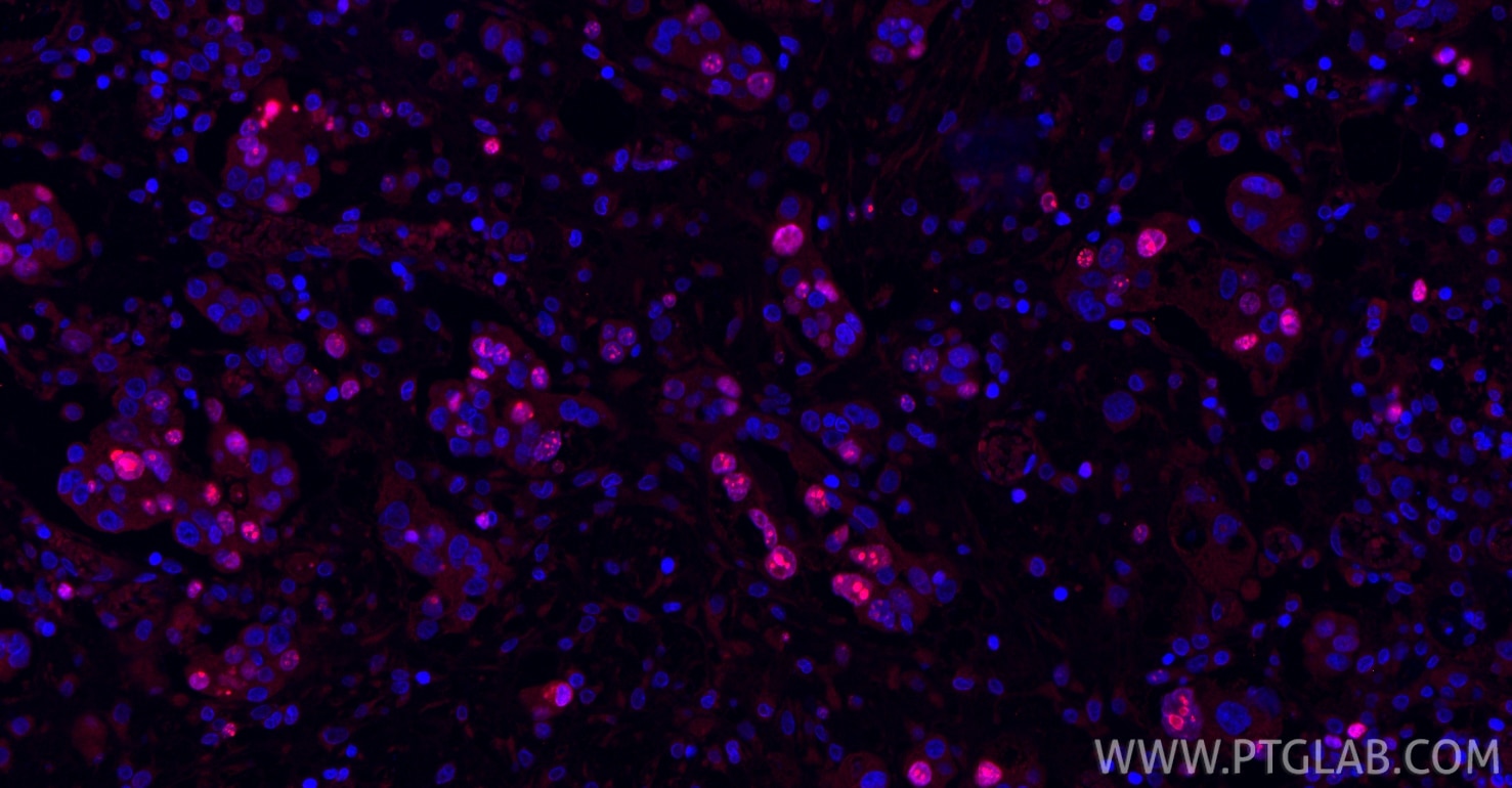 Immunofluorescence (IF) / fluorescent staining of human ovary cancer tissue using Ki-67 Monoclonal antibody (66555-6-Ig)