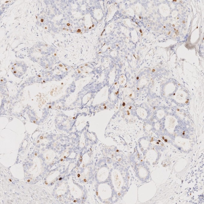 IHC staining of human breast cancer using 66555-6-Ig Immunohistochemistry (IHC) staining of human breast cancer tissue using Ki-67 Monoclonal antibody (66555-6-Ig)