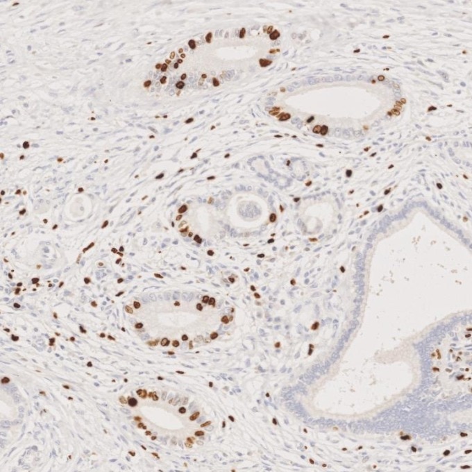 IHC staining of Cholangiocarcinoma using 66555-6-Ig Immunohistochemistry (IHC) staining of Cholangiocarcinoma tissue using Ki-67 Monoclonal antibody (66555-6-Ig)