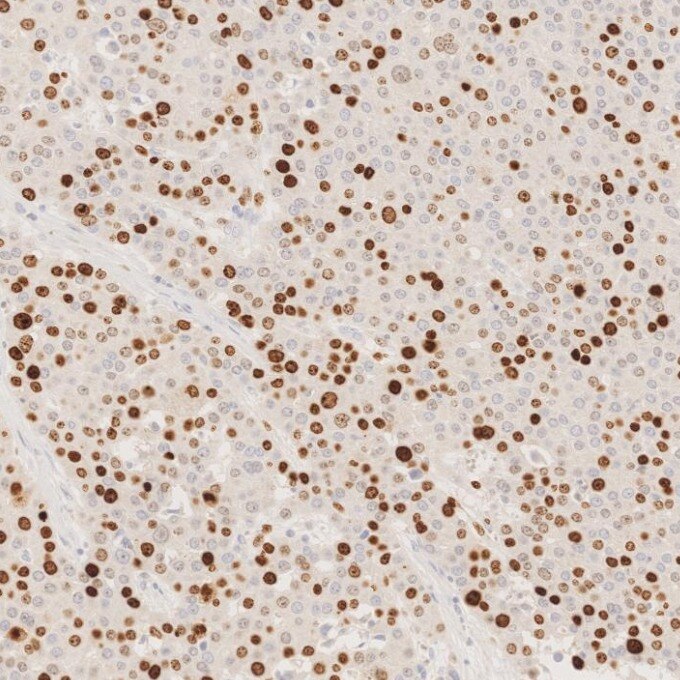 IHC staining of human liver cancer using 66555-6-Ig Immunohistochemistry (IHC) staining of human liver cancer tissue using Ki-67 Monoclonal antibody (66555-6-Ig)
