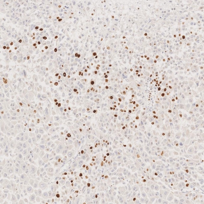IHC staining of human stomach cancer using 66555-6-Ig Immunohistochemistry (IHC) staining of human stomach cancer tissue using Ki-67 Monoclonal antibody (66555-6-Ig)
