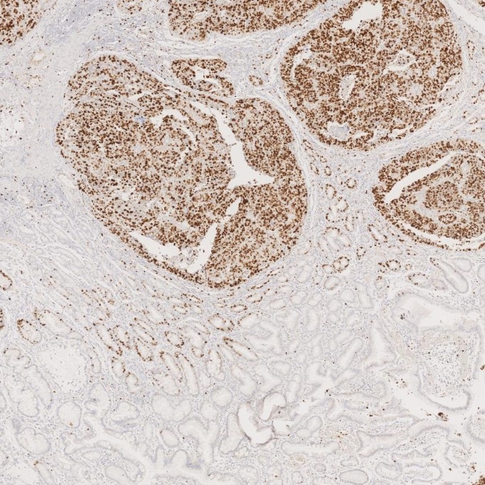 IHC staining of human stomach cancer using 66555-6-Ig Immunohistochemistry (IHC) staining of human stomach cancer tissue using Ki-67 Monoclonal antibody (66555-6-Ig)