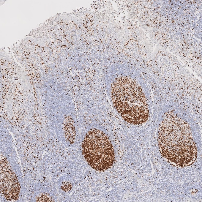 IHC staining of human tonsillitis using 66555-6-Ig Immunohistochemistry (IHC) staining of human tonsillitis tissue using Ki-67 Monoclonal antibody (66555-6-Ig)