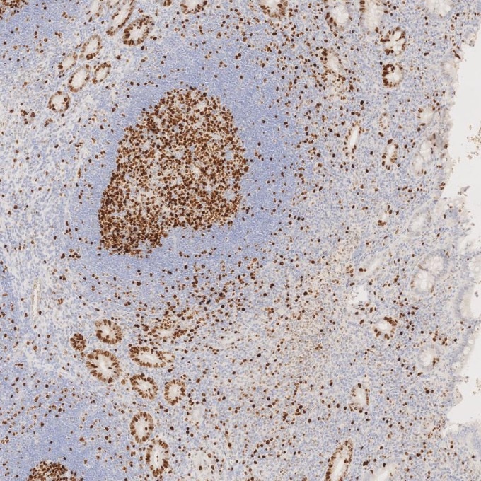 IHC staining of human appendicitis using 66555-6-Ig Immunohistochemistry (IHC) staining of human appendicitis tissue using Ki-67 Monoclonal antibody (66555-6-Ig)