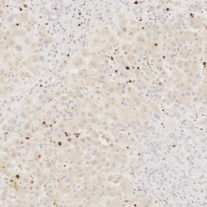 IHC staining of human liver using 66555-6-Ig Immunohistochemistry (IHC) staining of human liver tissue using Ki-67 Monoclonal antibody (66555-6-Ig)