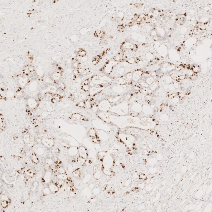 IHC staining of human pancreas cancer using 66555-6-Ig Immunohistochemistry (IHC) staining of human pancreas cancer tissue using Ki-67 Monoclonal antibody (66555-6-Ig)