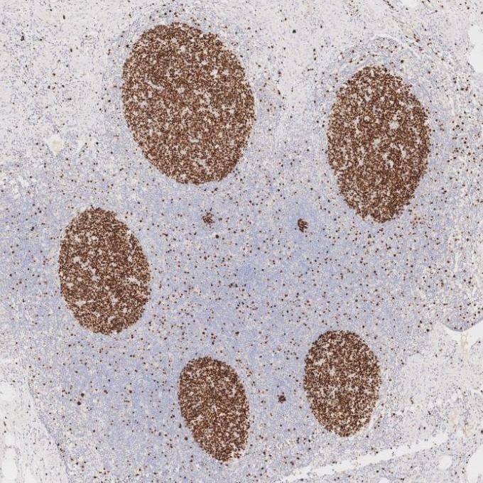 IHC staining of human appendicitis using 66555-6-Ig Immunohistochemistry (IHC) staining of human appendicitis tissue using Ki-67 Monoclonal antibody (66555-6-Ig)