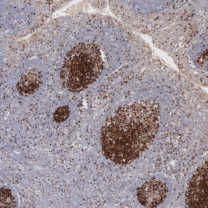 IHC staining of human tonsillitis using 66555-6-Ig Immunohistochemistry (IHC) staining of human tonsillitis tissue using Ki-67 Monoclonal antibody (66555-6-Ig)