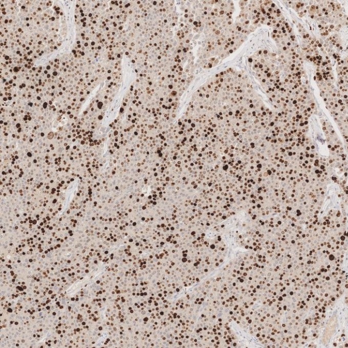 IHC staining of human liver cancer using 66555-6-Ig Immunohistochemistry (IHC) staining of human liver cancer tissue using Ki-67 Monoclonal antibody (66555-6-Ig)