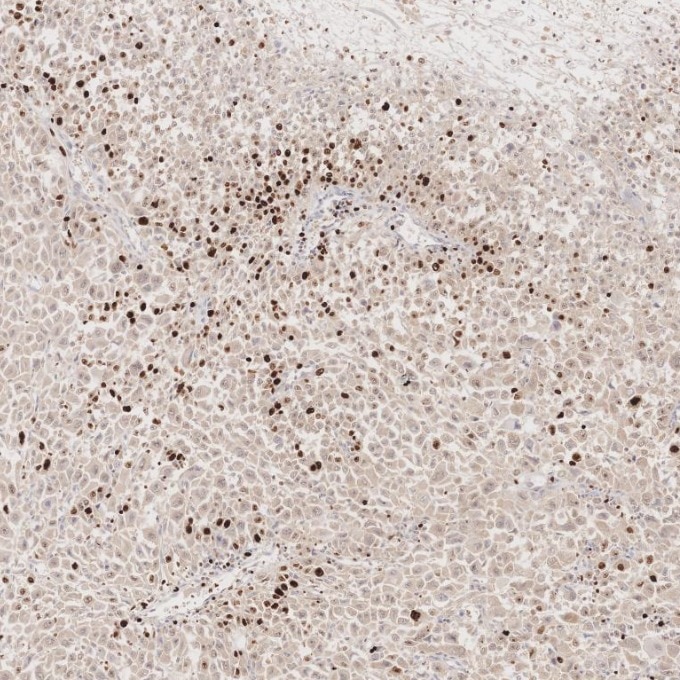 IHC staining of human stomach cancer using 66555-6-Ig Immunohistochemistry (IHC) staining of human stomach cancer tissue using Ki-67 Monoclonal antibody (66555-6-Ig)