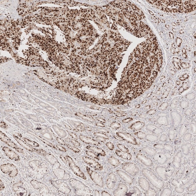 IHC staining of human stomach cancer using 66555-6-Ig Immunohistochemistry (IHC) staining of human stomach cancer tissue using Ki-67 Monoclonal antibody (66555-6-Ig)