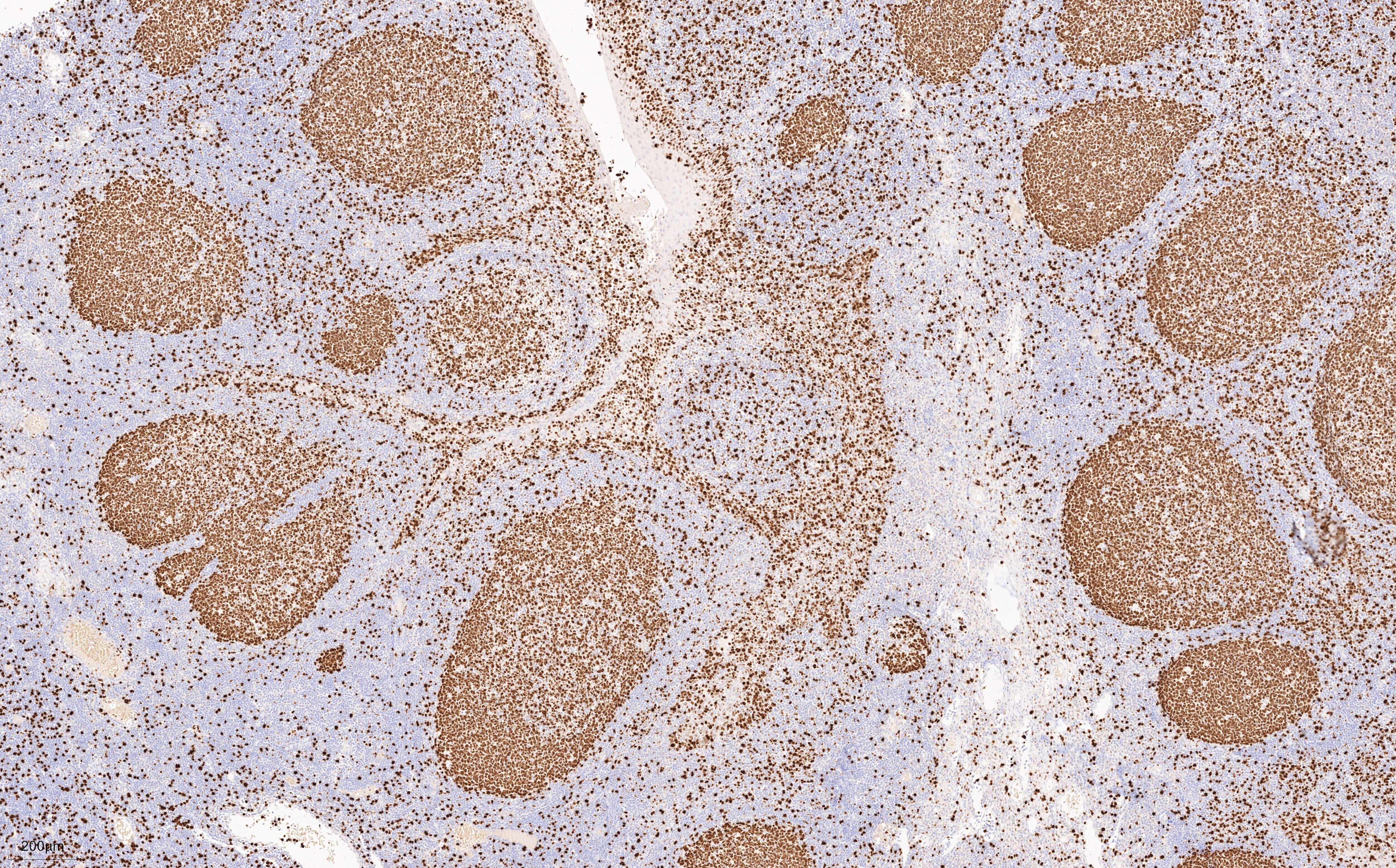 Immunohistochemistry (IHC) staining of human tonsillitis tissue using Ki-67 Recombinant monoclonal antibody (84192-4-RR)