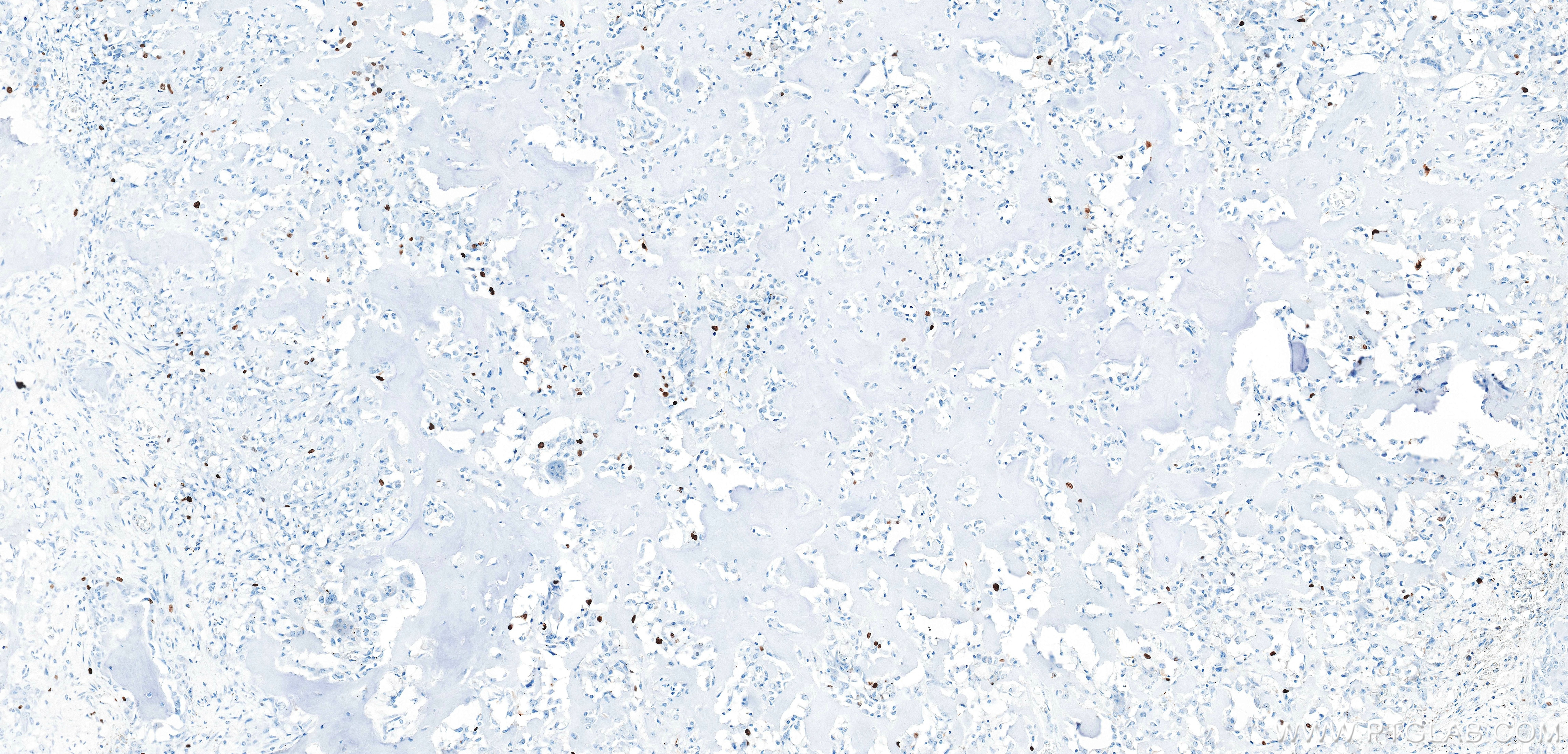 Immunohistochemistry (IHC) staining of human osteosarcoma tissue using Ki-67 Recombinant monoclonal antibody (84192-4-RR)
