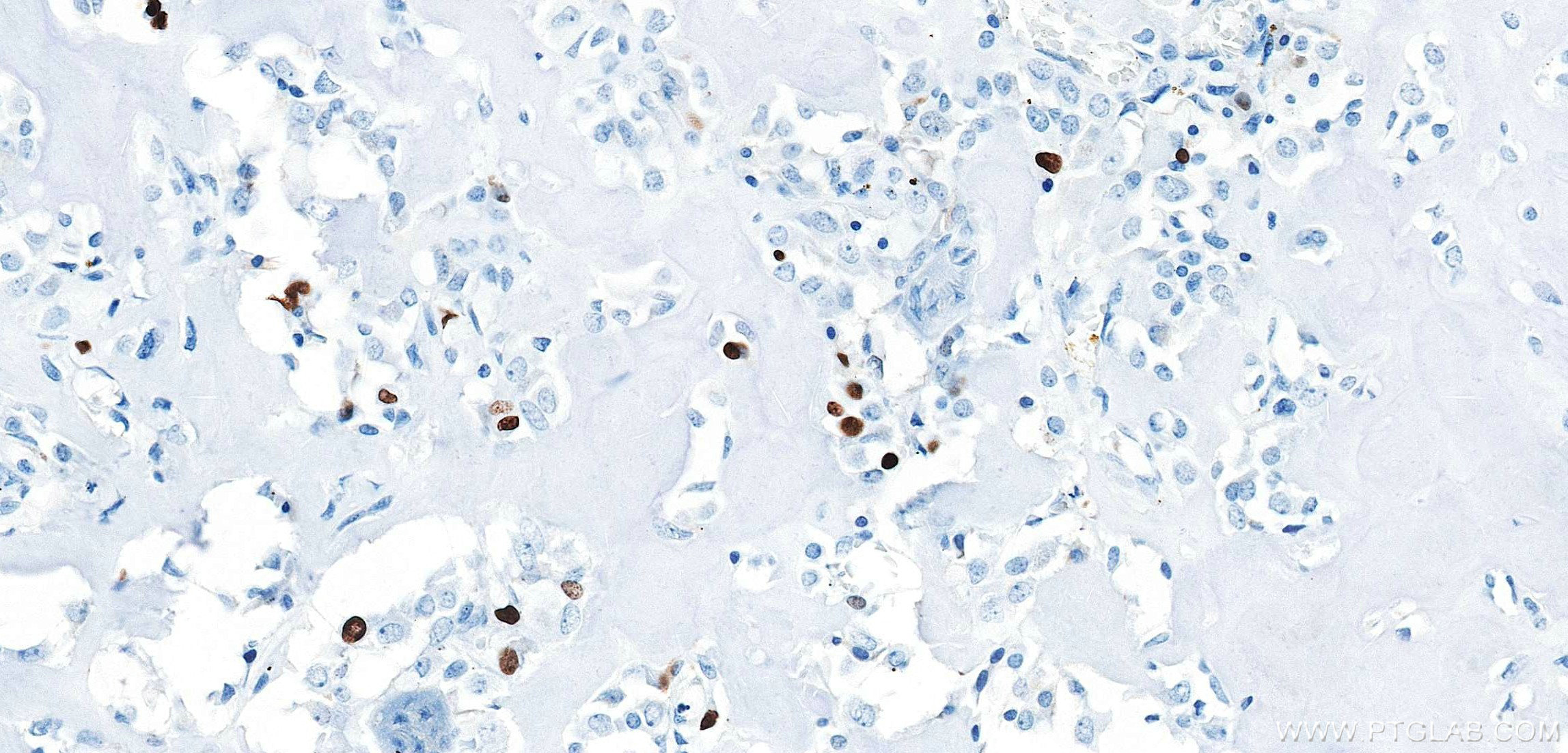 Immunohistochemistry (IHC) staining of human osteosarcoma tissue using Ki-67 Recombinant monoclonal antibody (84192-4-RR)