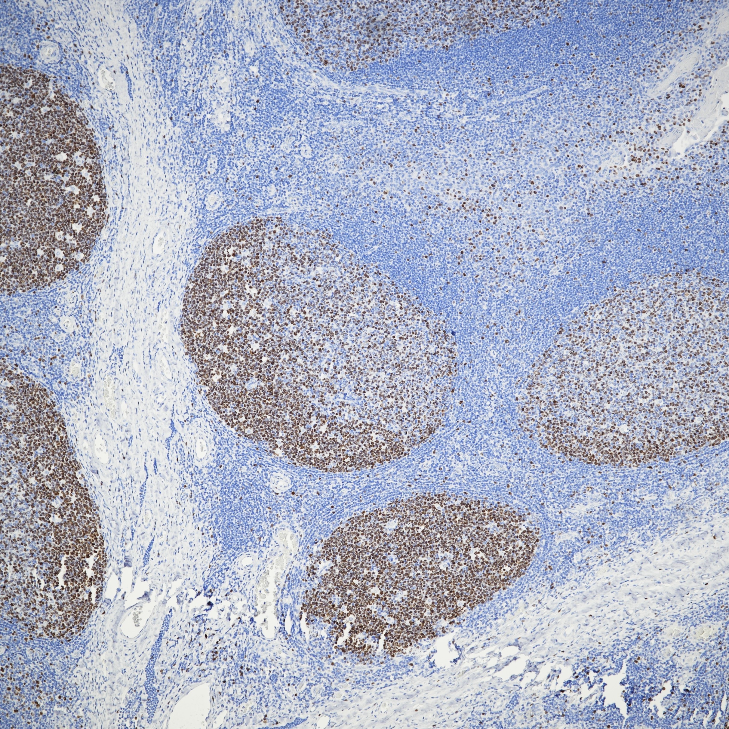 IHC staining of human tonsil using 84192-4-RR Immunohistochemistry (IHC) staining of human tonsil tissue using Ki-67 Recombinant monoclonal antibody (84192-4-RR)