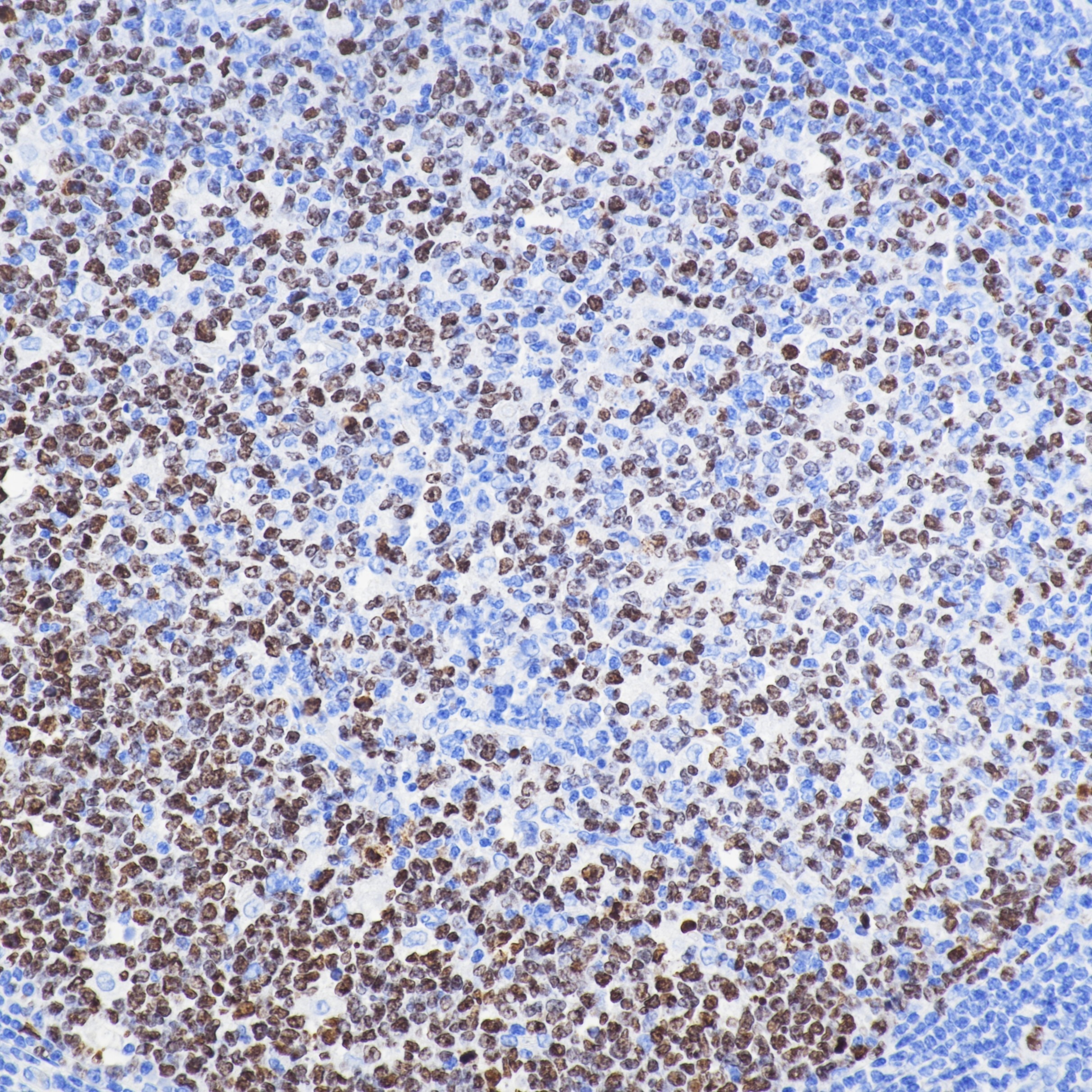 IHC staining of human tonsil using 84192-4-RR Immunohistochemistry (IHC) staining of human tonsil tissue using Ki-67 Recombinant monoclonal antibody (84192-4-RR)