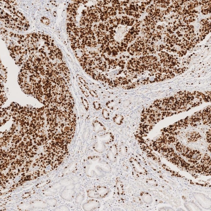 Immunohistochemistry (IHC) staining of human stomach cancer tissue using Ki-67 Recombinant monoclonal antibody (84192-4-RR)