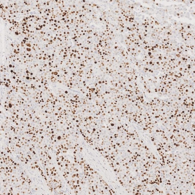 Immunohistochemistry (IHC) staining of human liver cancer tissue using Ki-67 Recombinant monoclonal antibody (84192-4-RR)