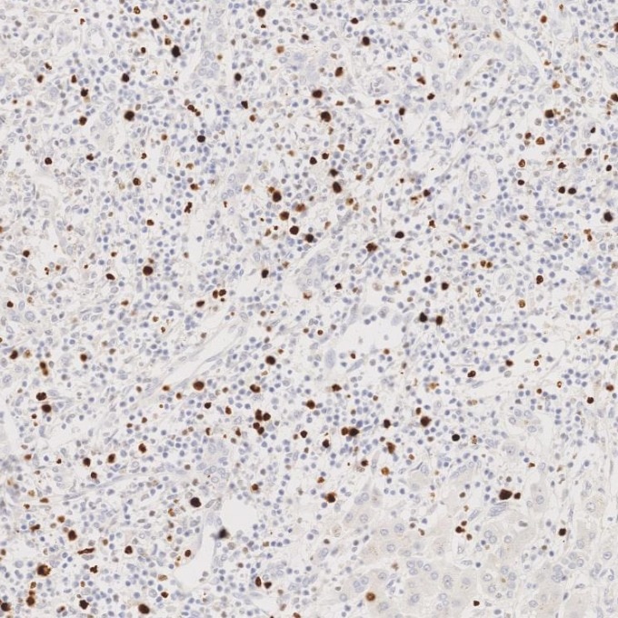 Immunohistochemistry (IHC) staining of Cholangiocarcinoma tissue using Ki-67 Recombinant monoclonal antibody (84192-4-RR)