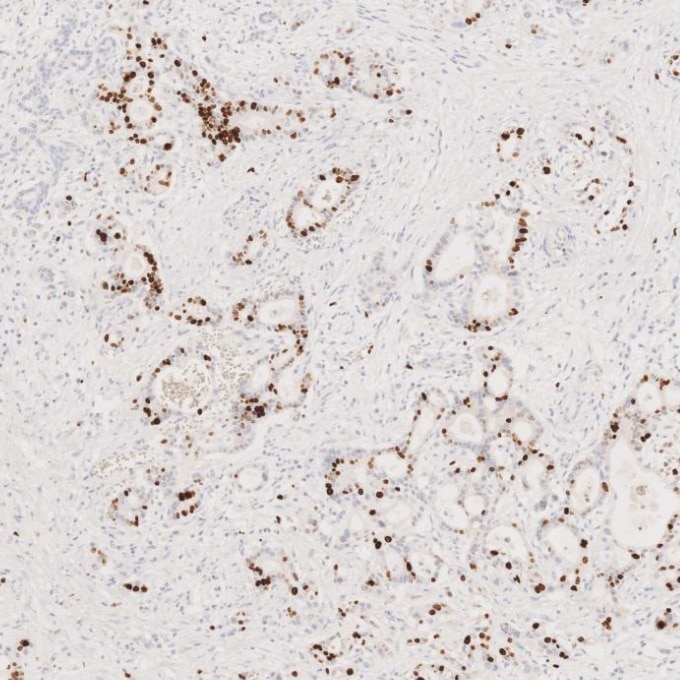 Immunohistochemistry (IHC) staining of human pancreas cancer tissue using Ki-67 Recombinant monoclonal antibody (84192-4-RR)