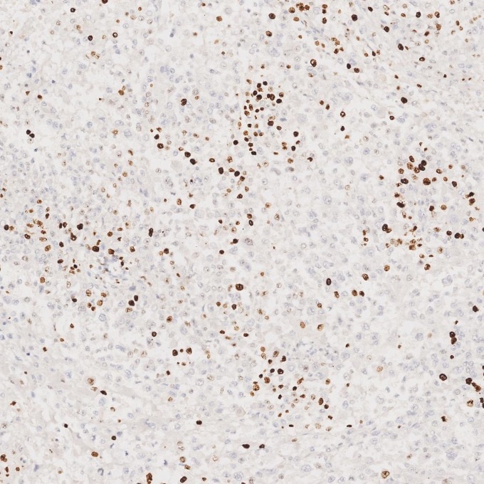 Immunohistochemistry (IHC) staining of human stomach cancer tissue using Ki-67 Recombinant monoclonal antibody (84192-4-RR)