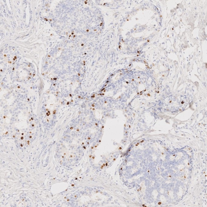 Immunohistochemistry (IHC) staining of human breast cancer tissue using Ki-67 Recombinant monoclonal antibody (84192-4-RR)