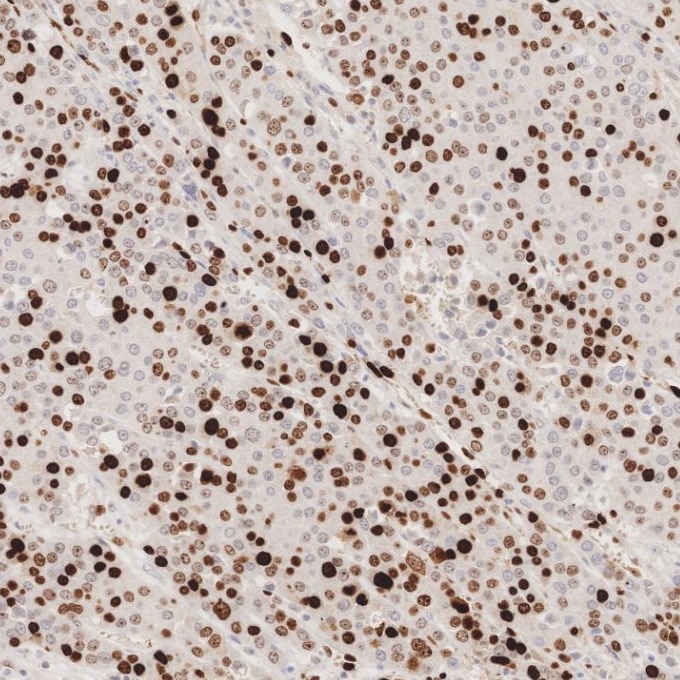 Immunohistochemistry (IHC) staining of human liver cancer tissue using Ki-67 Recombinant monoclonal antibody (84192-4-RR)