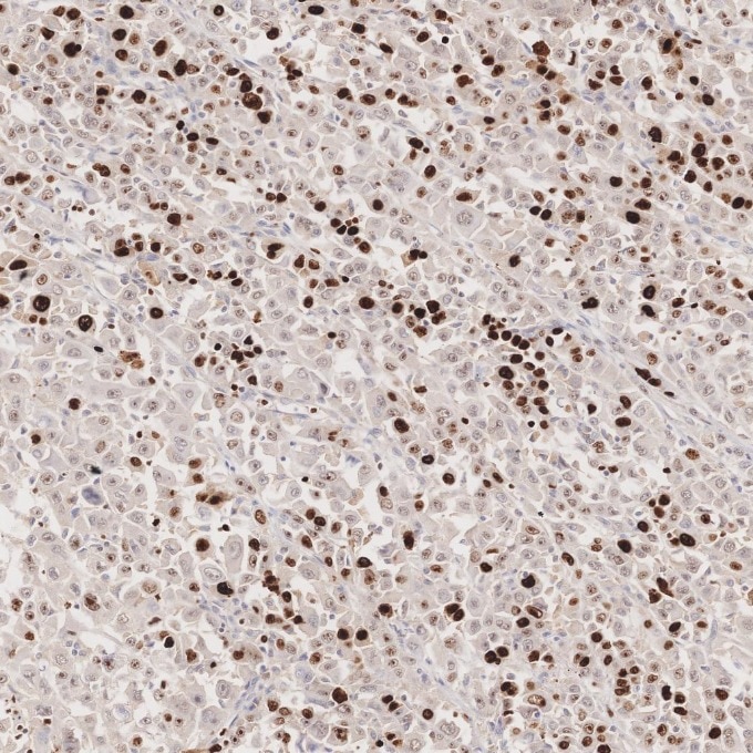 Immunohistochemistry (IHC) staining of human stomach cancer tissue using Ki-67 Recombinant monoclonal antibody (84192-4-RR)