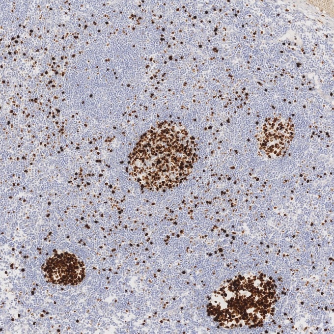 Immunohistochemistry (IHC) staining of human tonsillitis tissue using Ki-67 Recombinant monoclonal antibody (84192-4-RR)